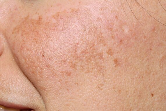 What’s causing this facial rash involving darker patches of skin?