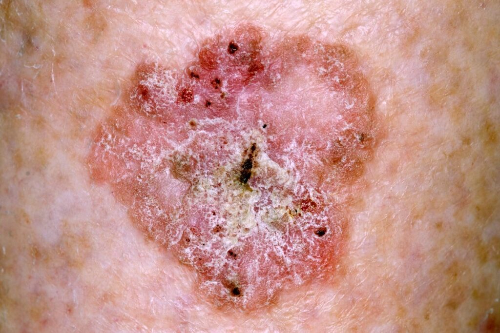 Close-up of a skin lesion on the shin of the leg of an 82 year old female patient due to Bowen's disease.
