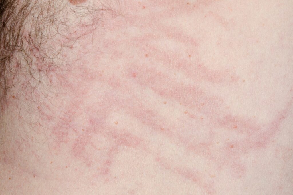 Urticaria. Red rash (hives) and scratches on the skin of a 48-year-old male patient with urticaria.
