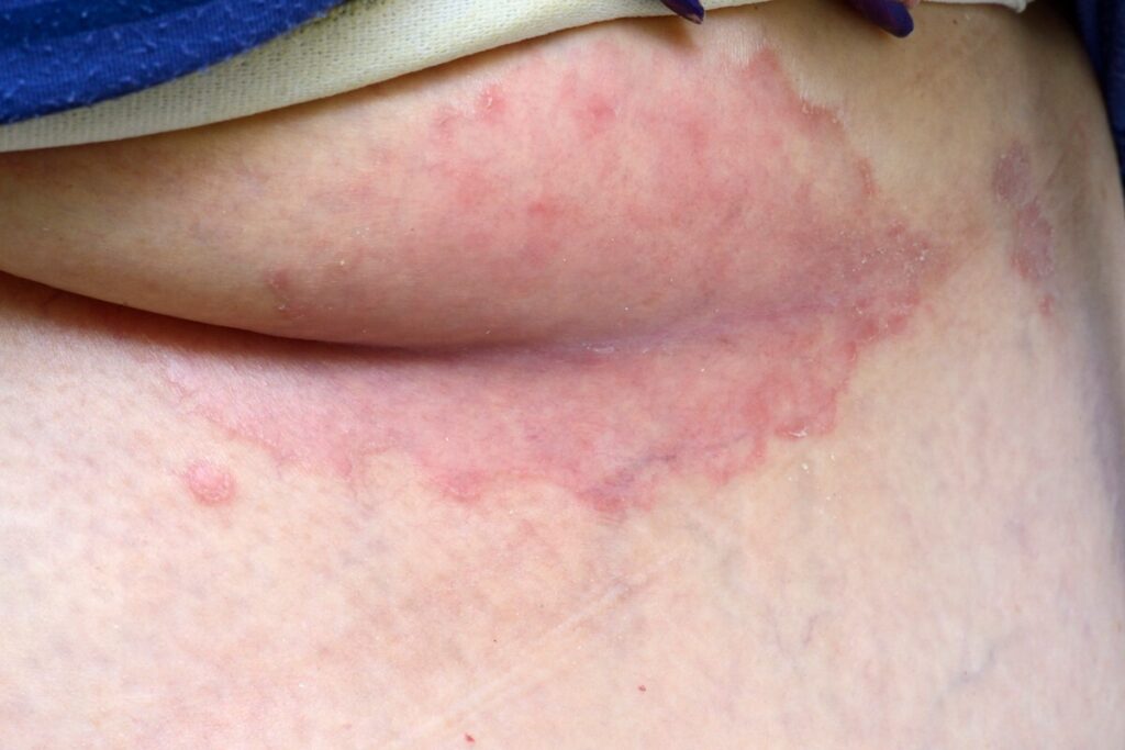 Flexural psoriasis below the breast. Red shiny patch of inflamed skin underneath the breast (submammary) in an adult female patient due to flexural psoriasis