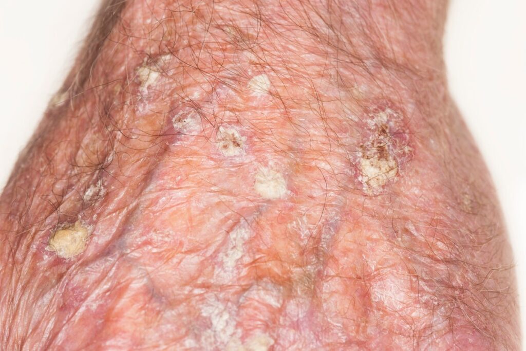 Solar keratoses on the hand of a 76 year old male patient