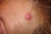 How to recognise and diagnose primary cutaneous lymphomas