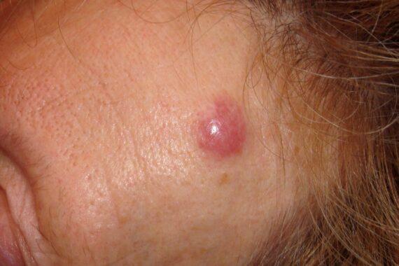 How to recognise and diagnose primary cutaneous lymphomas