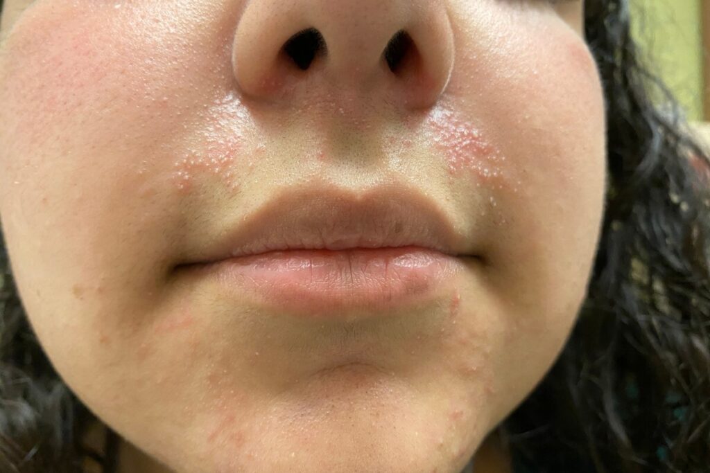 Dermatitis around the mouth and nose of an 18 year old Hispanic female patient