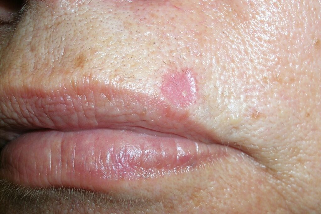 Basal cell carcinoma (BCC), or rodent ulcer, on a patient's upper lip
