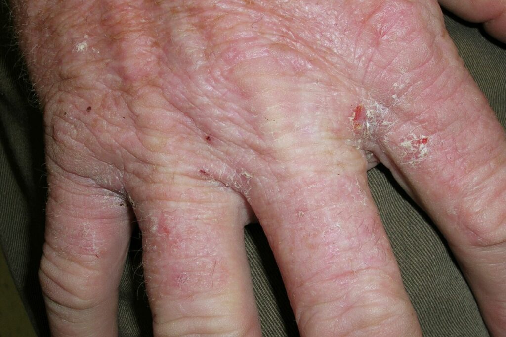 Crusted scabies infection on a patient's hand.