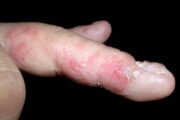 What is the cause of this intensely itchy, vesicular rash on the hands?
