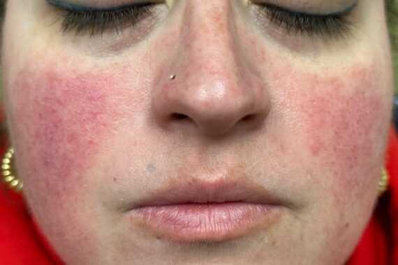 What is the diagnosis for this recurrent facial flushing?