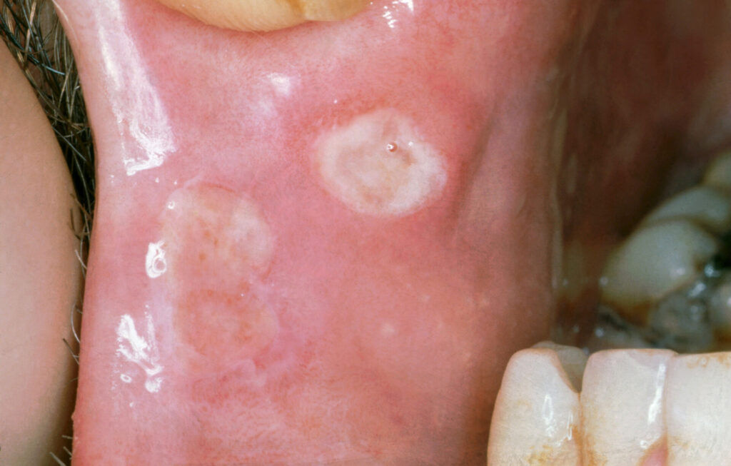 Oral aphthous ulcers seen in Behçet’s disease -
