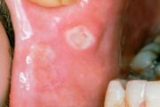 Behçet’s disease – what it is and how to spot it