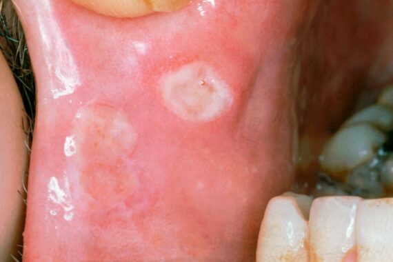 Behçet’s disease – what it is and how to spot it