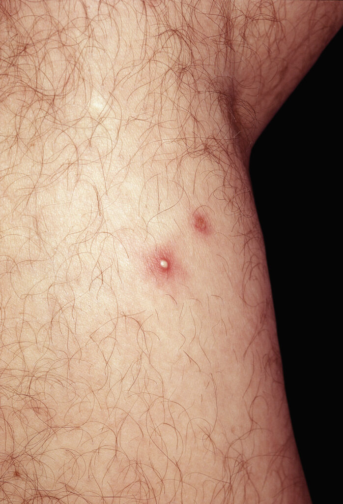 Papulopustular eruption on the skin of a male patient with Behçet’s disease.