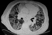 Key questions on pulmonary fibrosis and interstitial lung disease