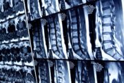 Axial spondyloarthritis – how to recognise it and what to do