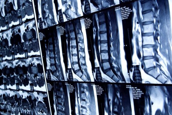 Axial spondyloarthritis – how to recognise it and what to do