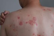 What is this widespread, mildly itchy rash that ‘came out of nowhere’?