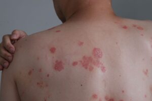 What is this widespread, mildly itchy rash that ‘came out of nowhere’?