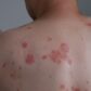 Close-up of back of male adult patient showing rash which is widespread and mildly itchy on trunk and back and arms due to guttate psoriasis