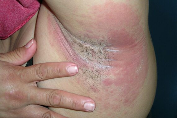 What is this mildly itchy, persistent rash affecting both axillae?