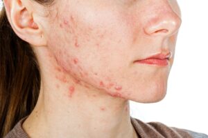 Acne: Why treatment can fail – and how to improve outcomes