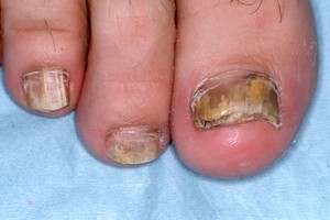 Clinical casebook: Common nail conditions