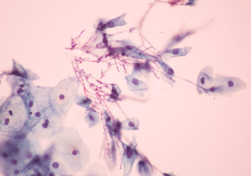 Advising on vaginal infections