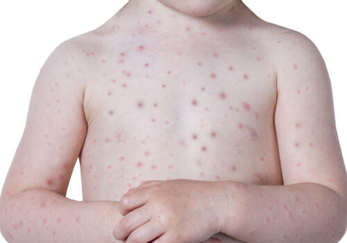 How to spot a rash part 2: examining a patient with a skin problem