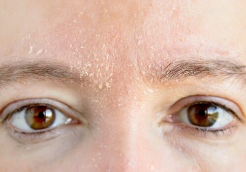 Advising patients on winter skin problems