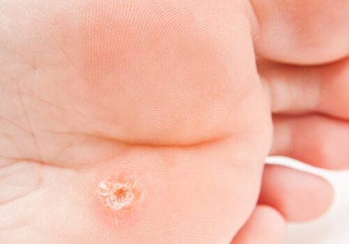Advising on warts and verrucae in community pharmacy