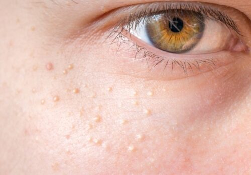 The best advice for patients with keratosis pilaris and milia