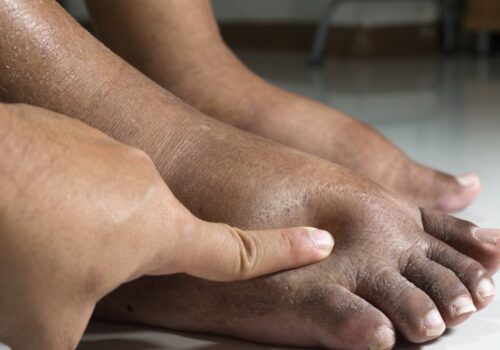 How community pharmacists can help prevent diabetic foot amputations