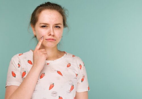 Pharmacy teams have an important role in the support of acne patients