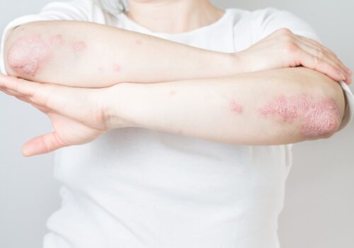 psoriasis awareness week