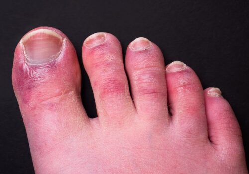 'Covid toe' may be side effect of antiviral response, study finds