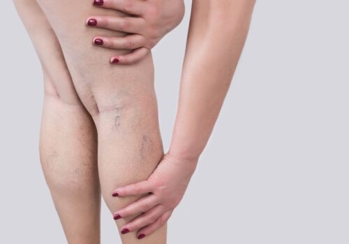 Risk of DVT increases for up to three months after Covid infection, study suggests