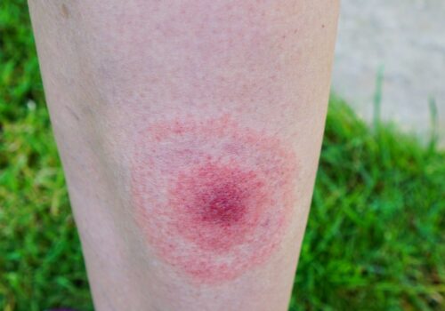 One in seven globally have likely had Lyme disease