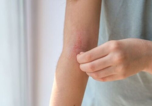 Dermatology quick quiz: Common eczema presentations
