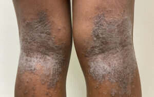 Close-up showing backs of knees in person with eczema with lichenification