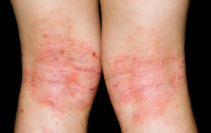 Close-up image of backs of knees in female patient with atopic eczema