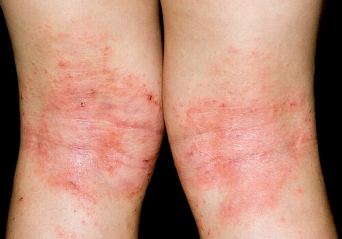 Close-up image of backs of knees in female patient with atopic eczema