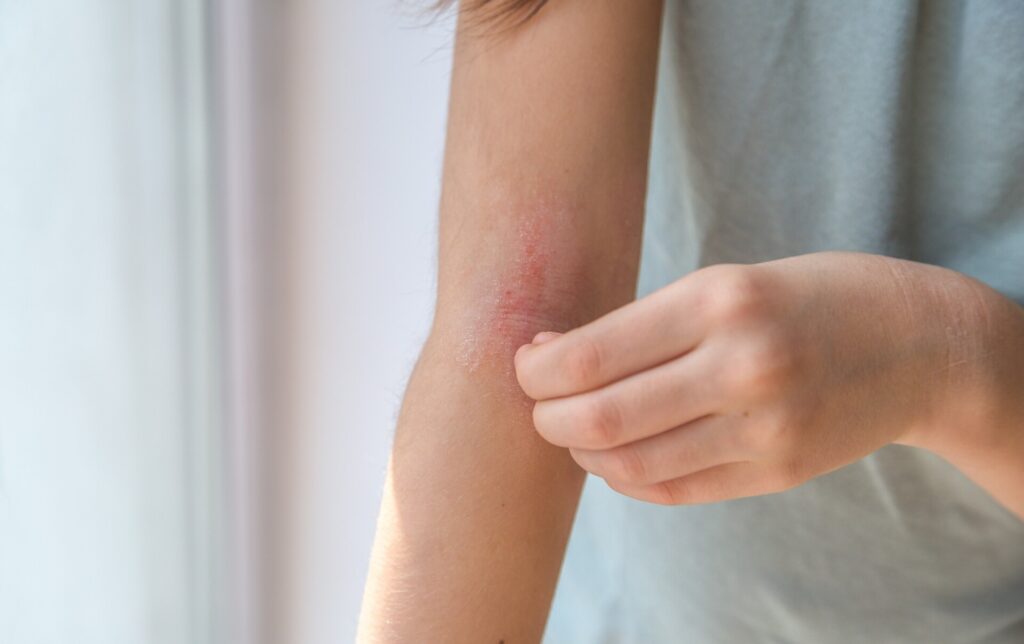 eczema on a young girls arm