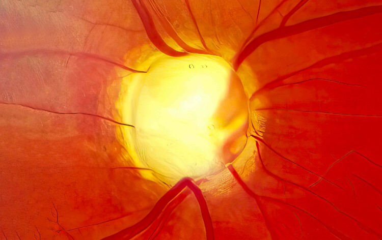 Optic nerve in advanced glaucoma disease