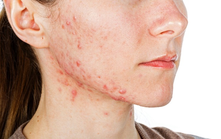 acne young girl