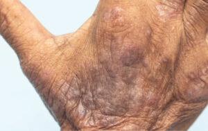 Eczema in hand