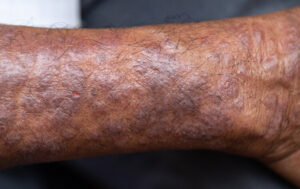 Eczema on arm