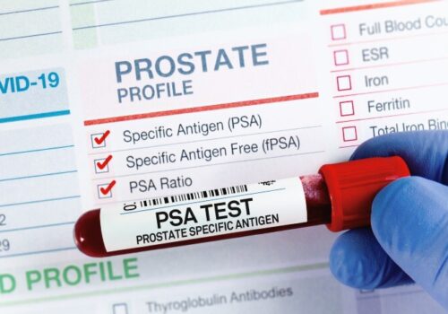 Blood sample for analysis of PSA Prostate Specific Antigen profile test in laboratory
