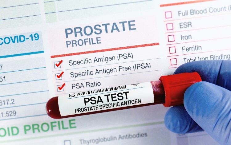 Blood sample for analysis of PSA Prostate Specific Antigen profile test in laboratory