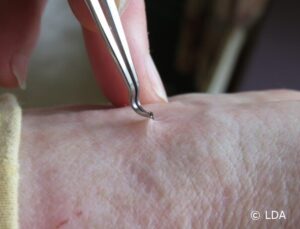 Tick removal tweezer LDA
