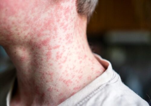 Measles viral disease, human skin covered with measles rash, vaccination concept