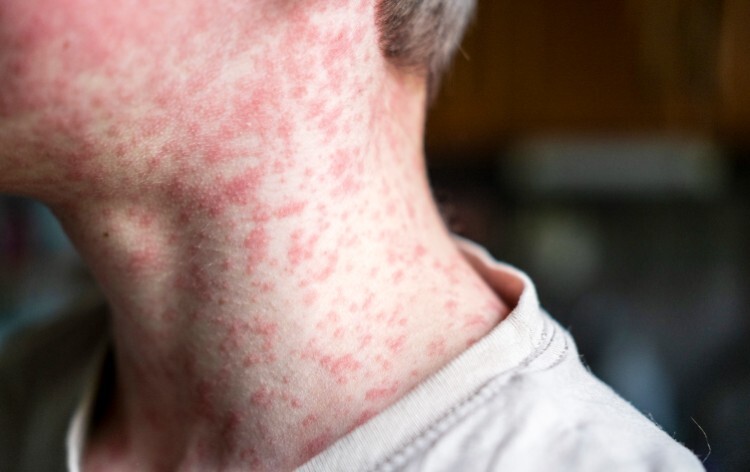 Two measles deaths reported in children this year, as national figures published by UKHSA